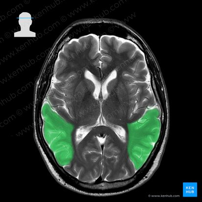 Temporal lobe (Lobus temporalis); Image: 