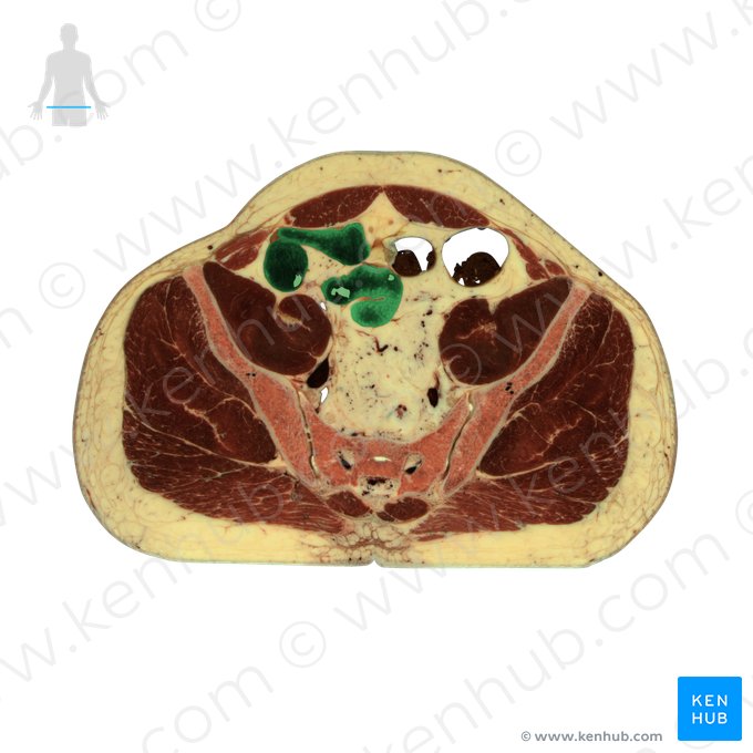 Ileum; Image: National Library of Medicine