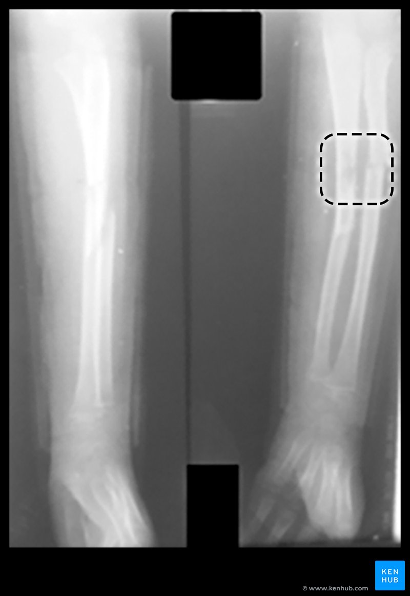 Radiographs of the forearm