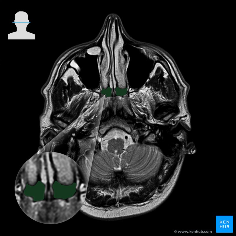 Choanae - axial view