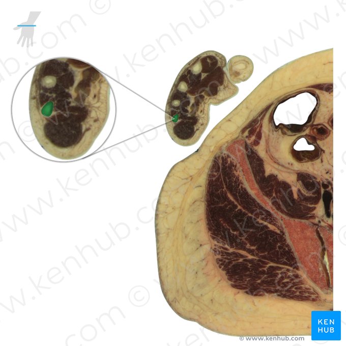 5th metacarpal bone (Os metacarpi 5); Image: National Library of Medicine