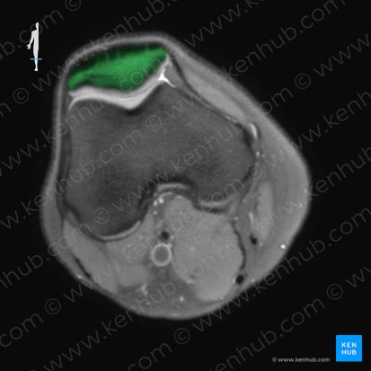 Patella (Kniescheibe); Bild: 