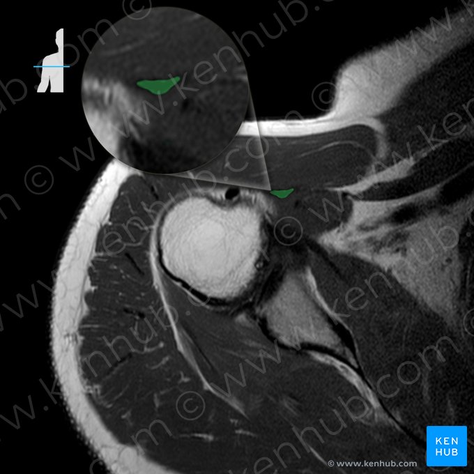 Tendón de la cabeza corta del músculo bíceps braquial (Tendo capitis brevis musculi bicipitis brachii); Imagen: 