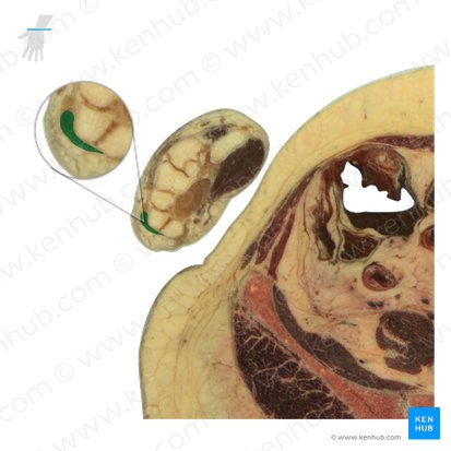 Tendão do músculo extensor ulnar do carpo (Tendo musculi extensoris carpi ulnaris); Imagem: National Library of Medicine