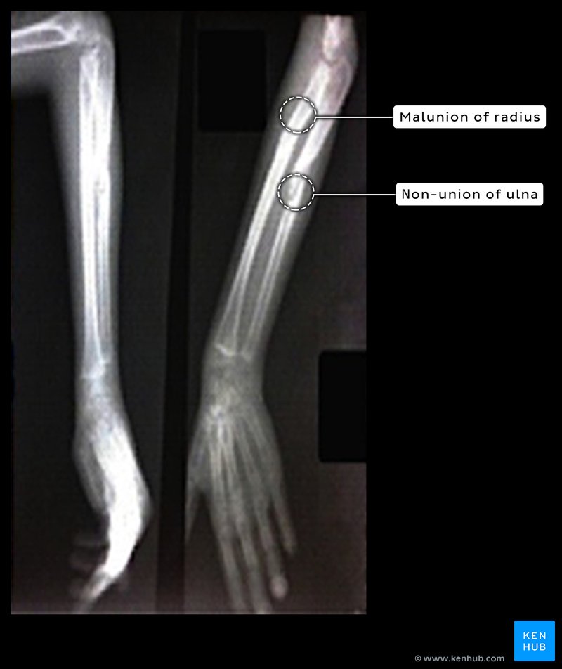 Malunion and non-union on X-ray