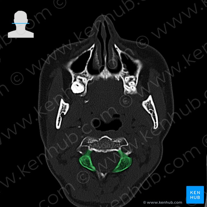 Vertebral arch of axis (Arcus vertebrae axis); Image: 