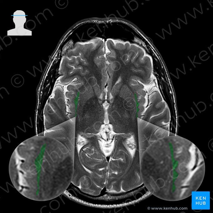 Claustro (Claustrum); Imagem: 