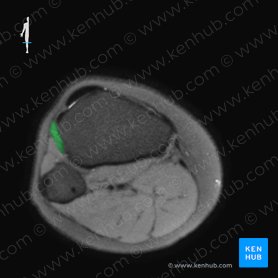 Musculus tibialis anterior (Vorderer Schienbeinmuskel); Bild: 