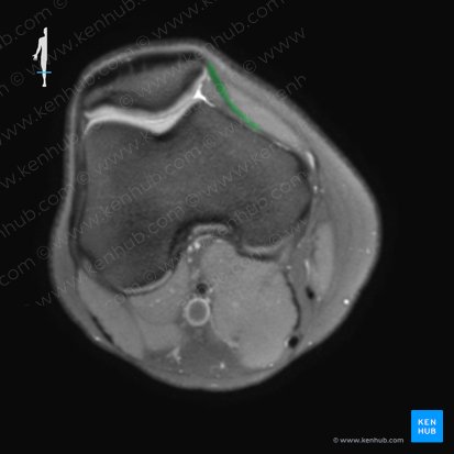 Retinaculum patellae mediale (Innerer Kniescheibenzügel); Bild: 