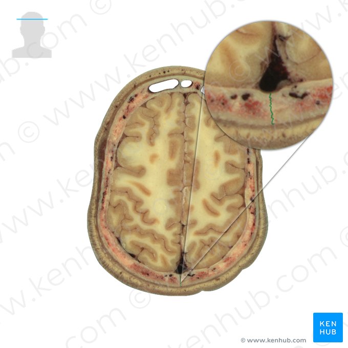 Sutura sagital (Sutura sagittalis); Imagem: National Library of Medicine