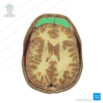 Frontal sinus (Sinus frontalis); Image: National Library of Medicine