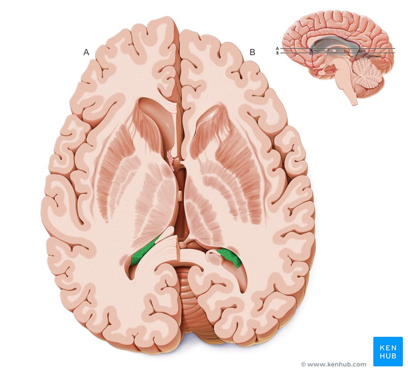 Choroid plexus - cross-sectional view