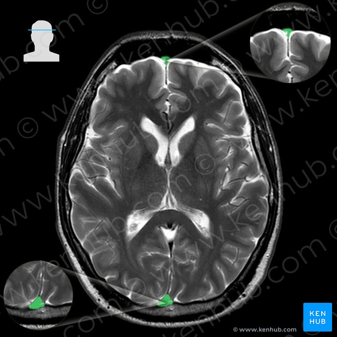 Seno sagital superior (Sinus sagittalis superior); Imagen: 