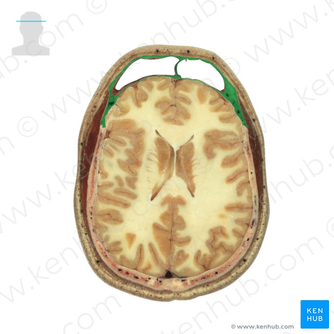 Frontal bone (Os frontale); Image: National Library of Medicine