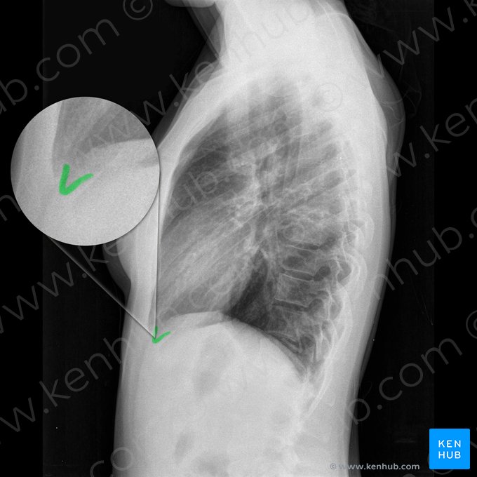 Ângulo costofrênico anterior esquerdo (Angulus costophrenicus anterior sinister); Imagem: 