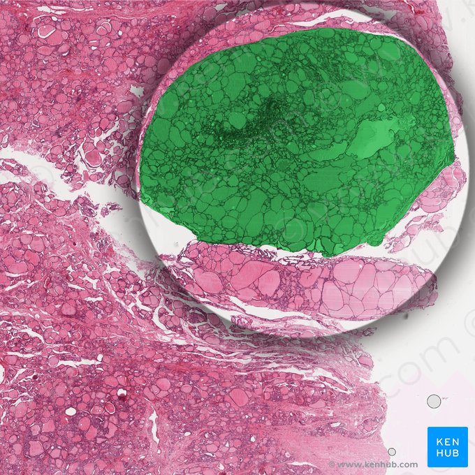 Thyroid lobule (Lobulus thyroideus); Image: 