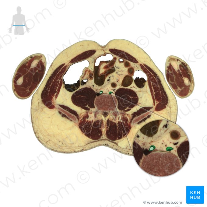 Artéria ilíaca comum (Arteria iliaca communis); Imagem: National Library of Medicine