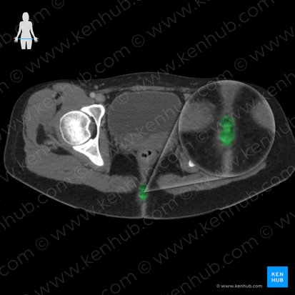 Coccyx (Os coccygis); Image: 