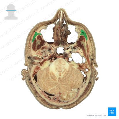 Os zygomaticum (Jochbein); Bild: National Library of Medicine