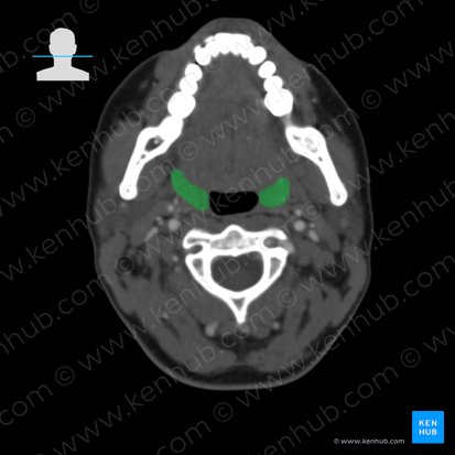 Palatine tonsil (Tonsilla palatina); Image: 