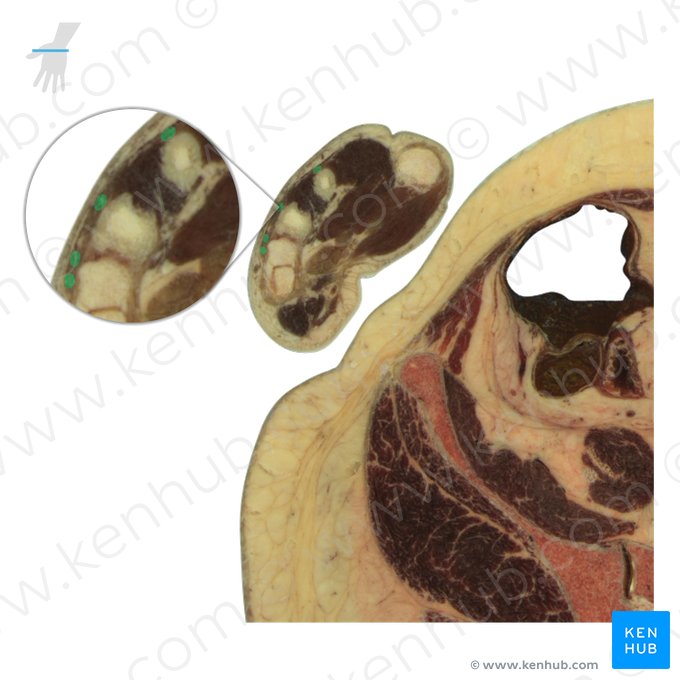 Tendões do músculo extensor dos dedos (Tendines musculi extensoris digitorum); Imagem: National Library of Medicine