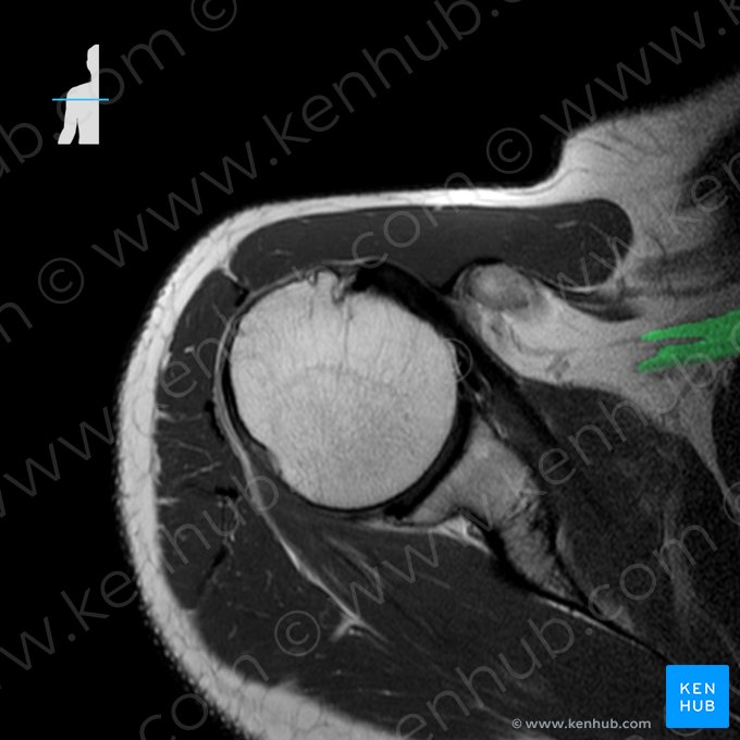 Plexus brachialis (Armgeflecht); Bild: 