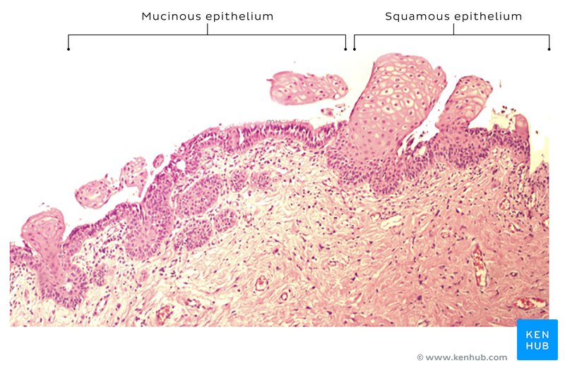 Benign Müllerian cyst lined with mucinous and squamous epithelium