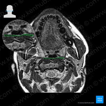 Middle pharyngeal constrictor muscle (Musculus constrictor medius pharyngis); Image: 