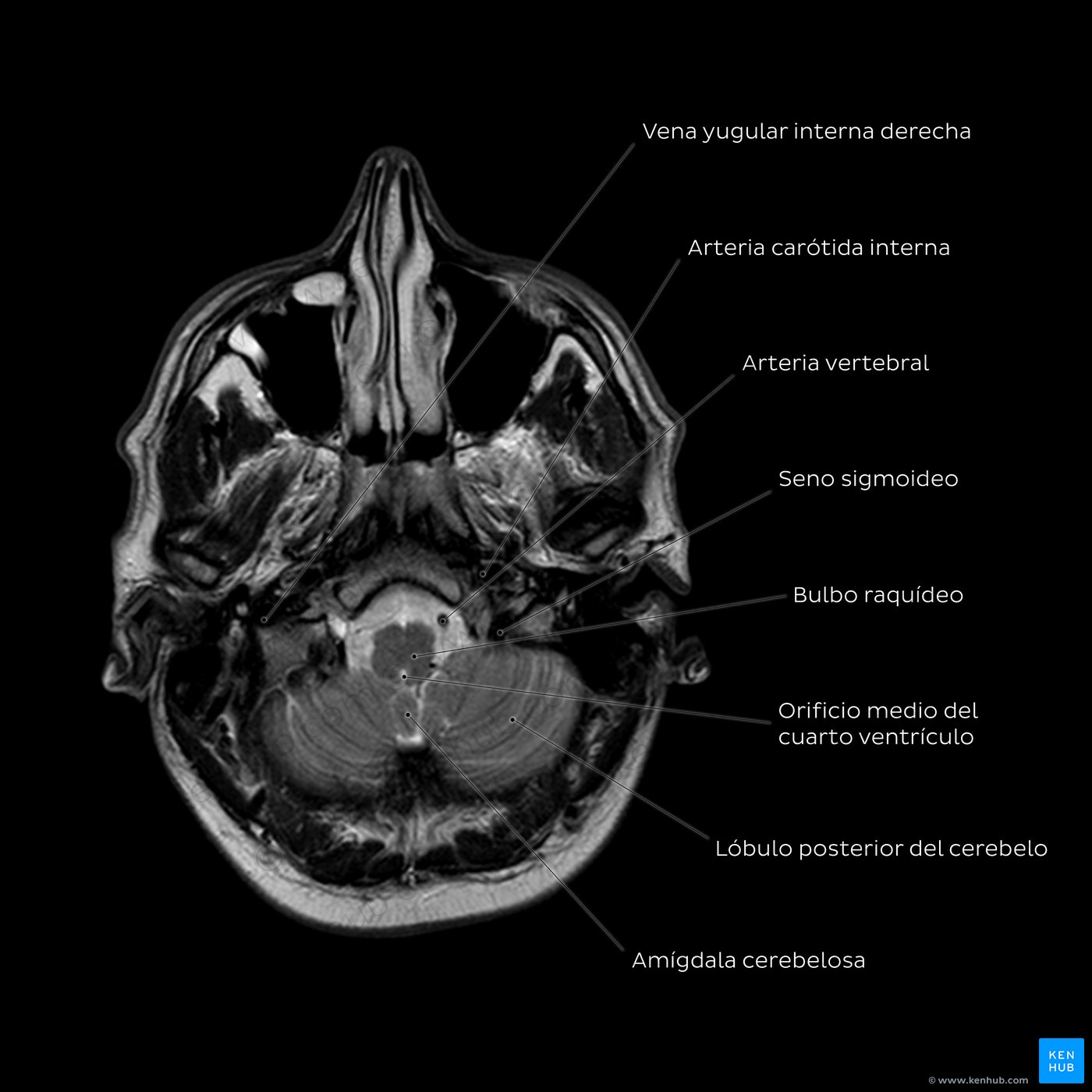 Resonancia magnética del cerebro