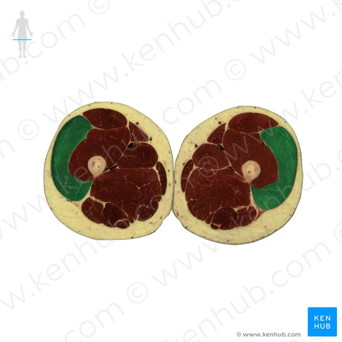 Músculo vasto lateral (Musculus vastus lateralis); Imagem: National Library of Medicine