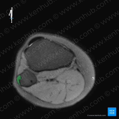 Ligamento colateral fibular de la articulación de la rodilla (Ligamentum collaterale fibulare genus); Imagen: 