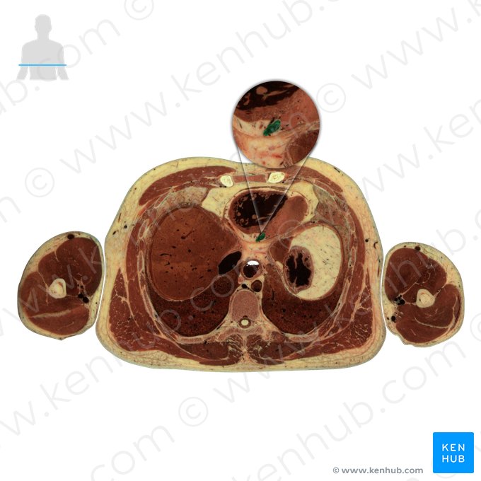 Middle cardiac vein (Vena cardiaca media); Image: National Library of Medicine