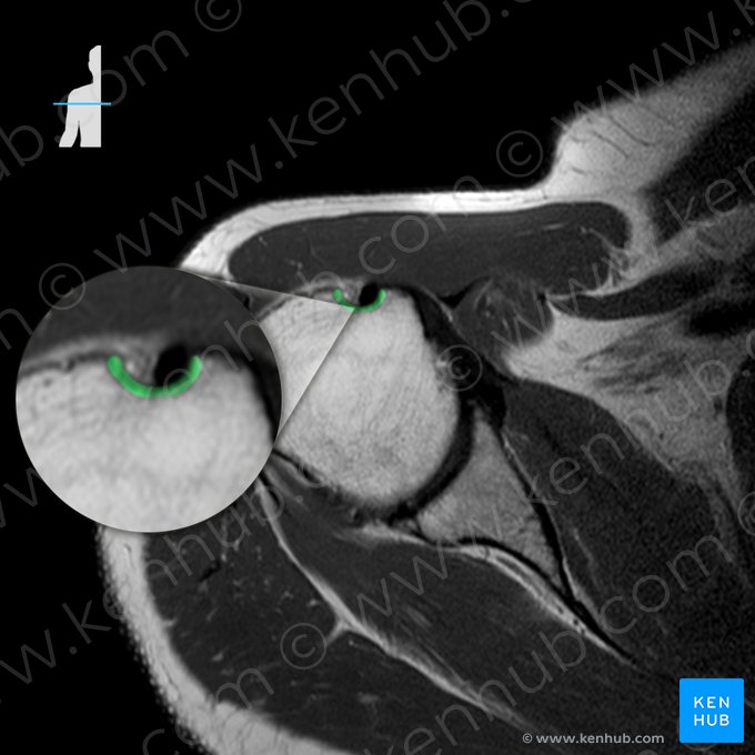 Sulco intertubercular do úmero (Sulcus intertubercularis humeri); Imagem: 