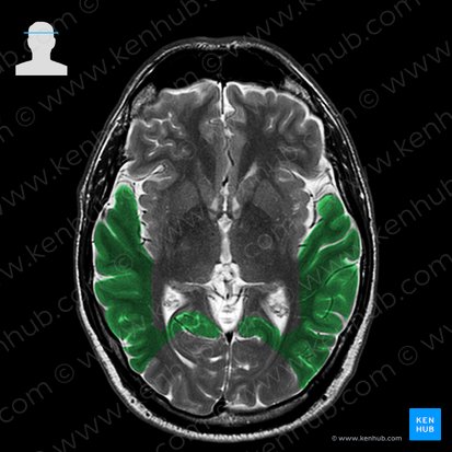 Lobus temporalis (Schläfenlappen); Bild: 