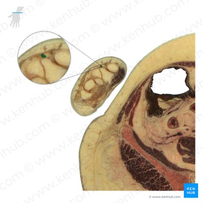 Tendão do músculo extensor longo do polegar (Tendo musculi extensoris pollicis longi); Imagem: National Library of Medicine