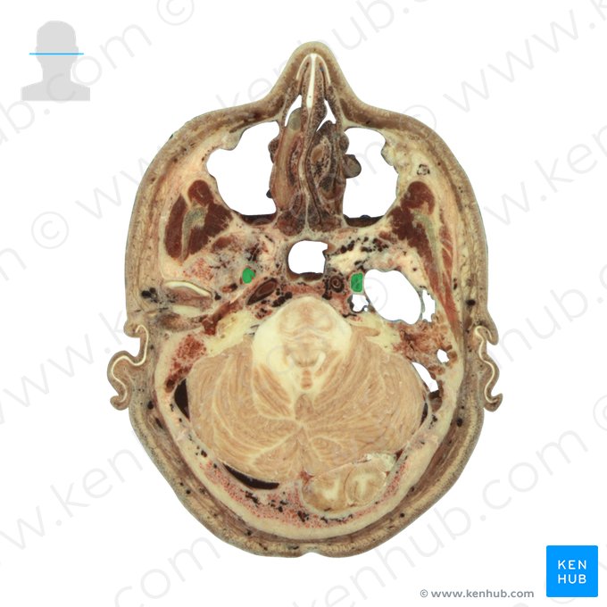 Mandibular nerve (Nervus mandibularis); Image: National Library of Medicine