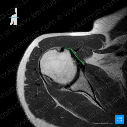 Tendon of subscapularis muscle (Tendo musculi subscapularis); Image: 