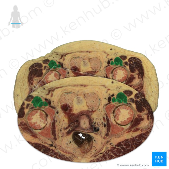 Musculus iliopsoas (Darmbein-Lenden-Muskel); Bild: National Library of Medicine