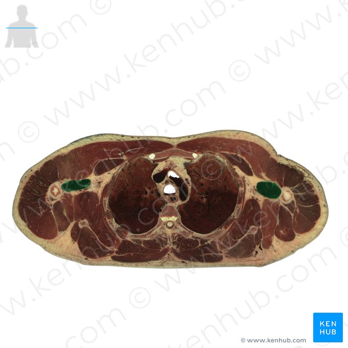 Músculo coracobraquial (Musculus coracobrachialis); Imagem: National Library of Medicine