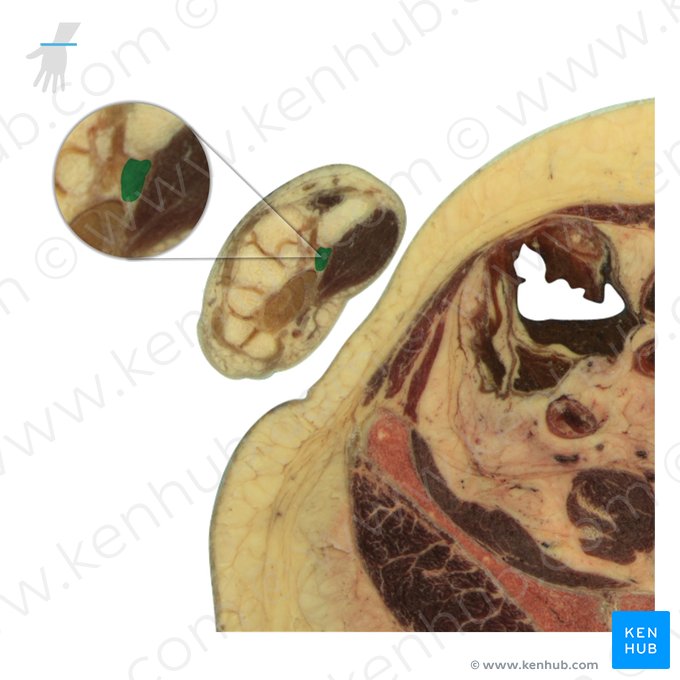 Tendo musculi flexoris carpi radialis (Sehne des speichenseitigen Handbeugers); Bild: National Library of Medicine