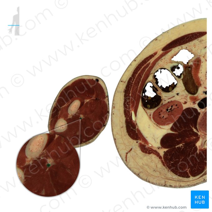 Artéria ulnar (Arteria ulnaris); Imagem: National Library of Medicine