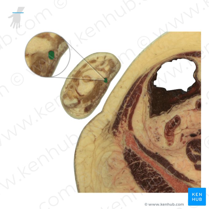 Tendão do músculo flexor radial do carpo (Tendo musculi flexoris carpi radialis); Imagem: National Library of Medicine