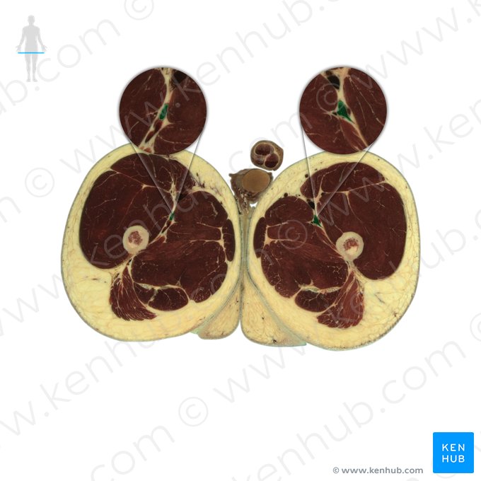 Vena profunda femoris (Tiefe Oberschenkelvene); Bild: National Library of Medicine