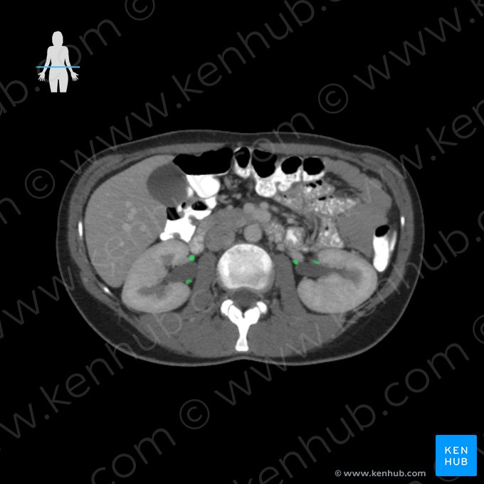 Ramos da artéria renal (Rami arteriae renalis); Imagem: 