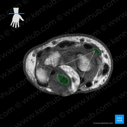 Tendon of extensor carpi radialis longus muscle (Tendo musculi extensoris carpi radialis longi); Image: 