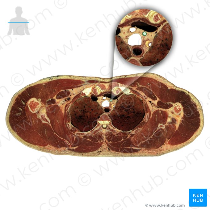 Artéria carótida comum esquerda (Arteria carotis communis sinistra); Imagem: National Library of Medicine