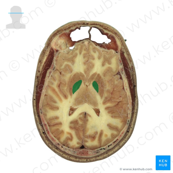 Globo pálido (Globus pallidus); Imagem: National Library of Medicine