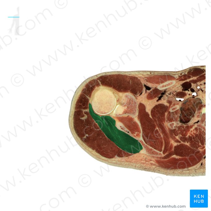 Musculus infraspinatus (Untergrätenmuskel); Bild: National Library of Medicine