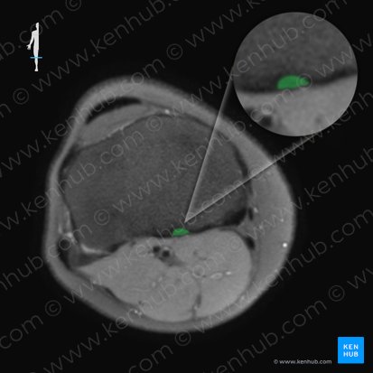 Posterior cruciate ligament (Ligamentum cruciatum posterius); Image: 