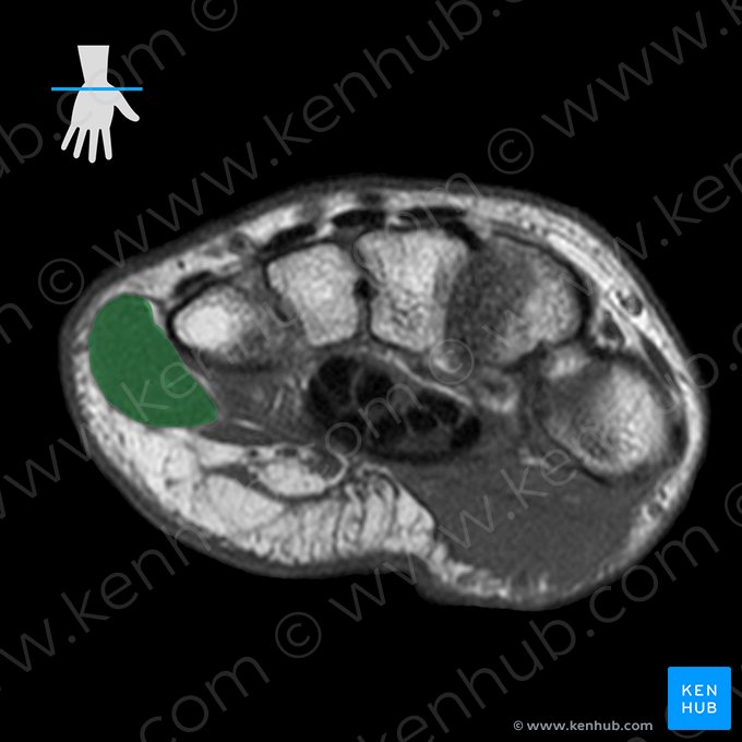 Abductor digiti minimi muscle of hand (Musculus abductor digiti minimi manus); Image: 